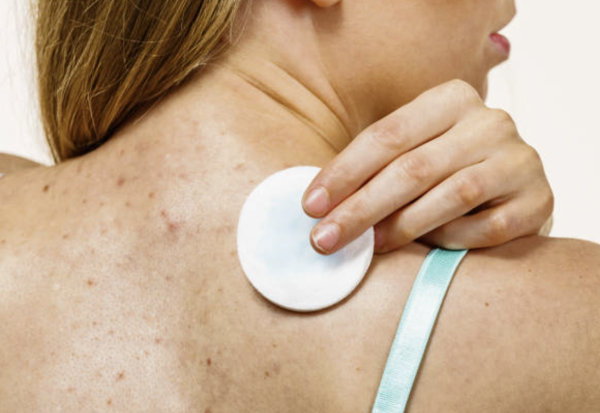 背部暗瘡 圖片來源：iStock