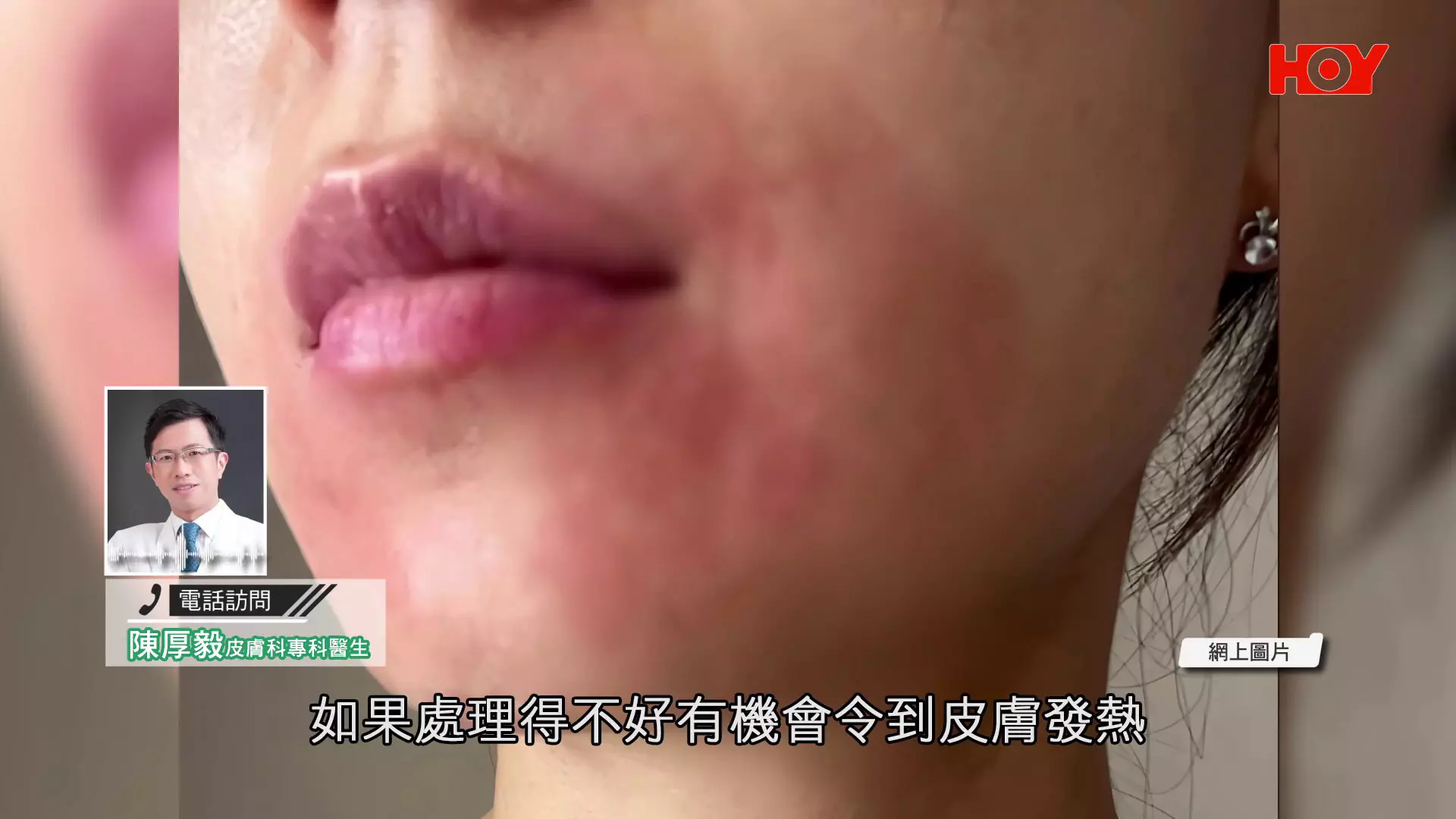 一線搜查｜港女敷面膜30分鐘雙眼紅腫刺痛！醫生揭2類成份容易致敏+3大安全須知