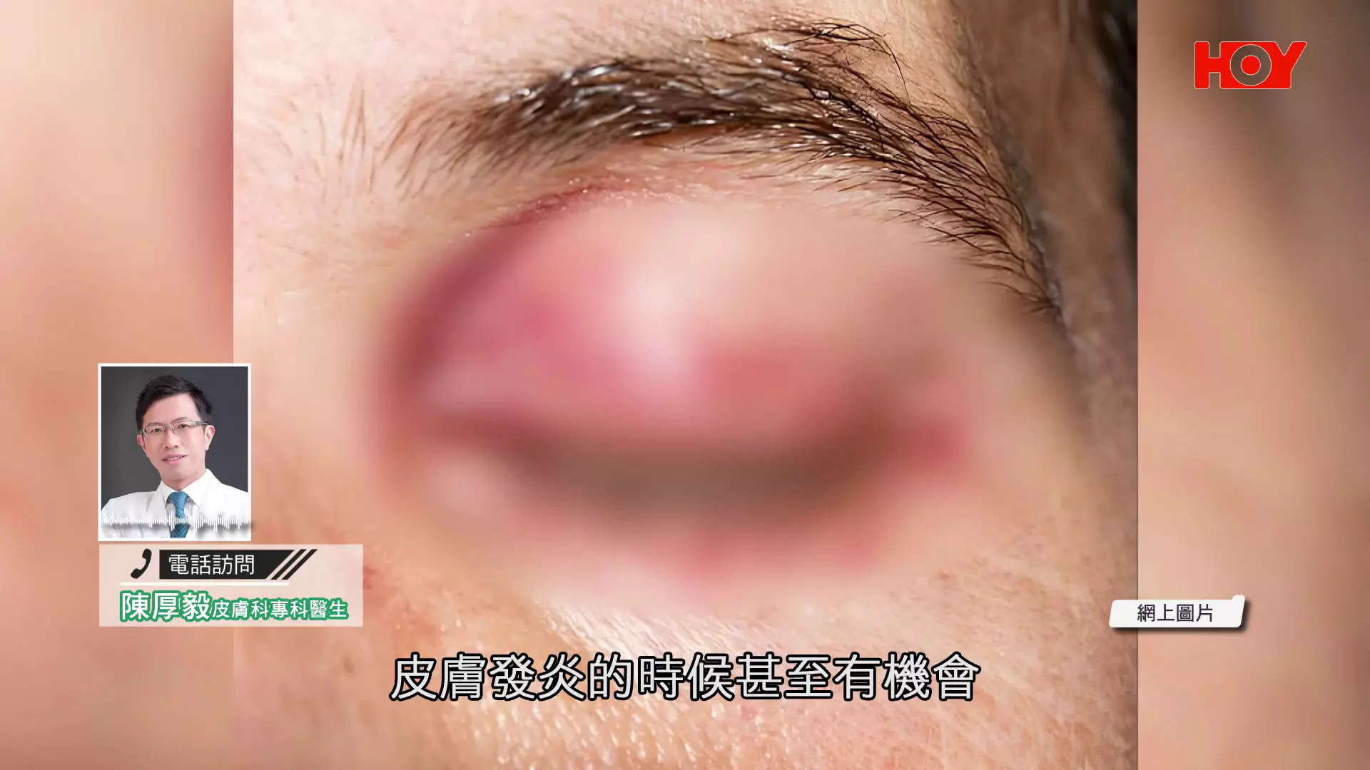 一線搜查｜港女敷面膜30分鐘雙眼紅腫刺痛！醫生揭2類成份容易致敏+3大安全須知