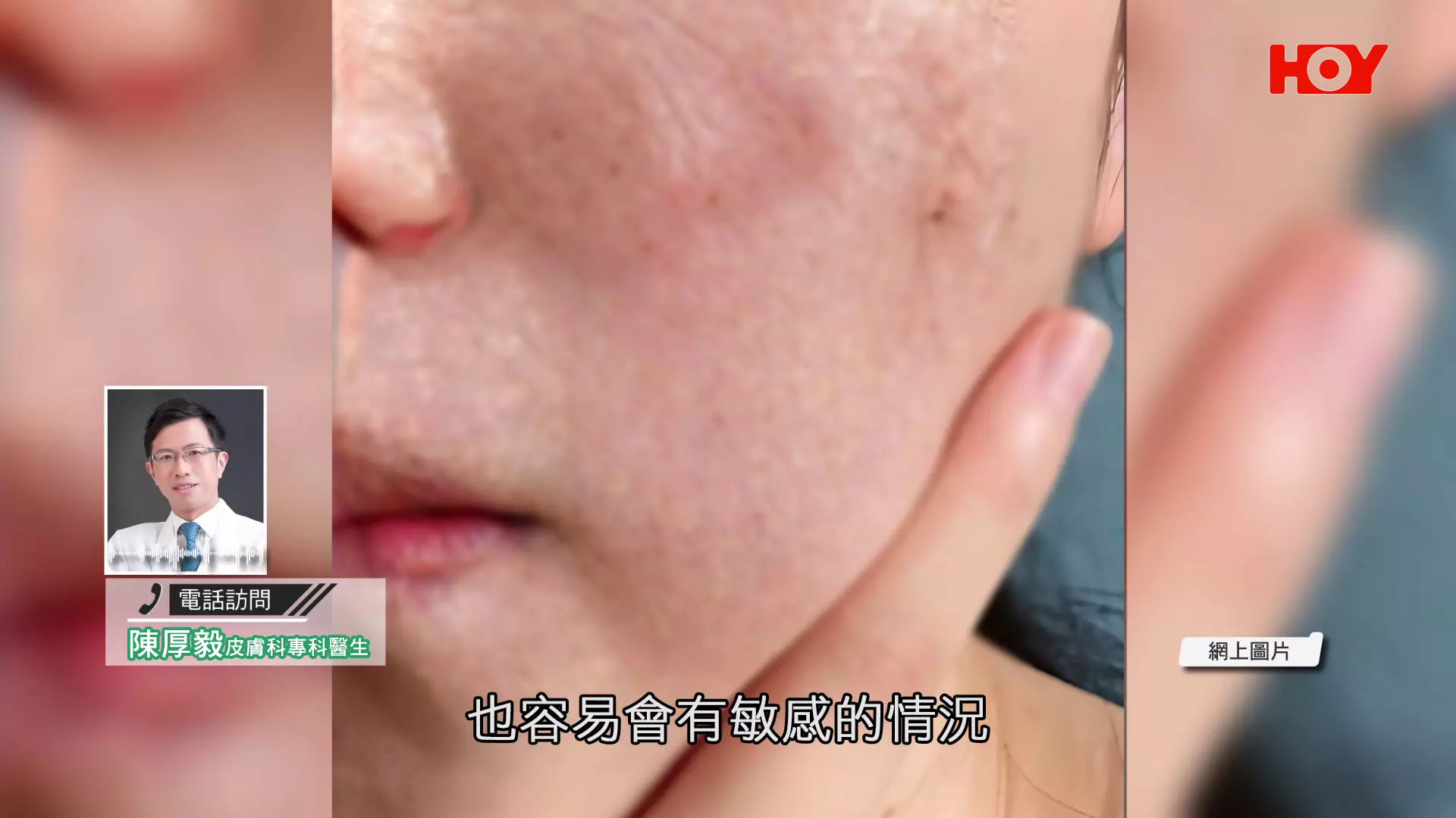 一線搜查｜港女敷面膜30分鐘雙眼紅腫刺痛！醫生揭2類成份容易致敏+3大安全須知