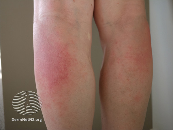 （圖片來源︰dermnetnz.org）