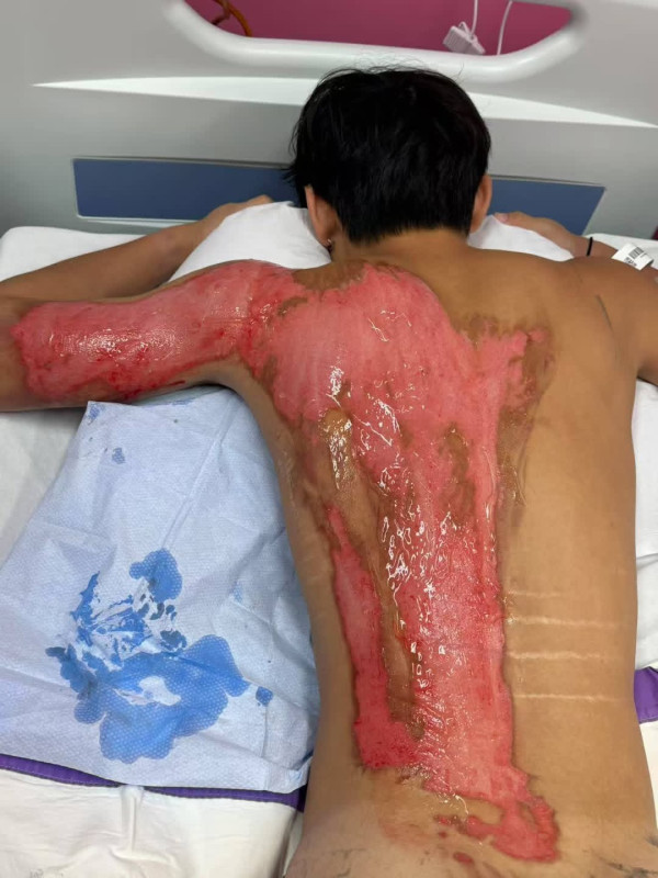 米線店燙傷19歲青年 背脊大面積二級灼傷 住院5日仍淌血水