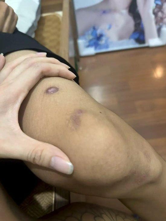 緬甸KK園區｜19歲男遭17歲女友以10萬蚊「賣豬仔」 慘遭毒打耳朵失聰 家人支付6位數贖金 