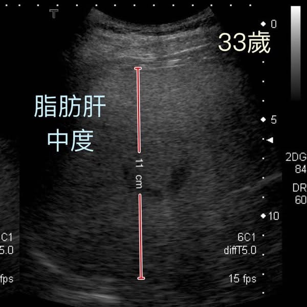 48歲男不煙不酒驚患末期肝硬化須換肝！醫生揭OO當水飲惹禍：肝臟萎縮剩1/3