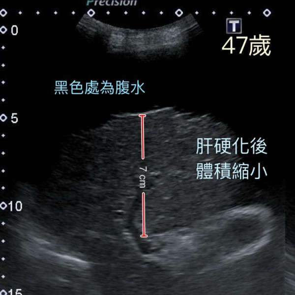 48歲男不煙不酒驚患末期肝硬化須換肝！醫生揭OO當水飲惹禍：肝臟萎縮剩1/3