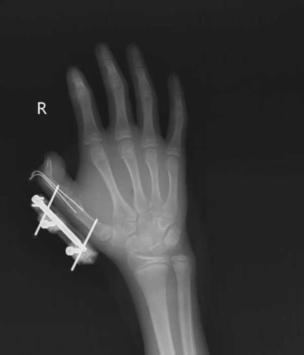 14歲仔搖晃乾冰爆炸受傷！虎口炸烈見白骨險斷