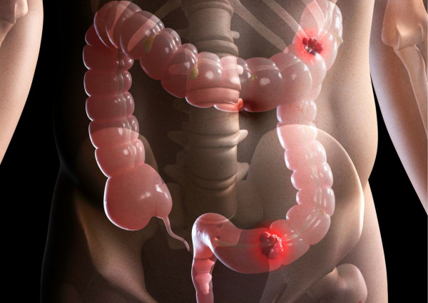 【大腸癌】20多歲患末期大腸癌  不煙不酒30歲同事亦險中！醫生：或和工作有關