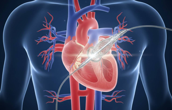 主動脈瓣狹窄勿輕忽：微創手術TAVI助你重拾健康心臟