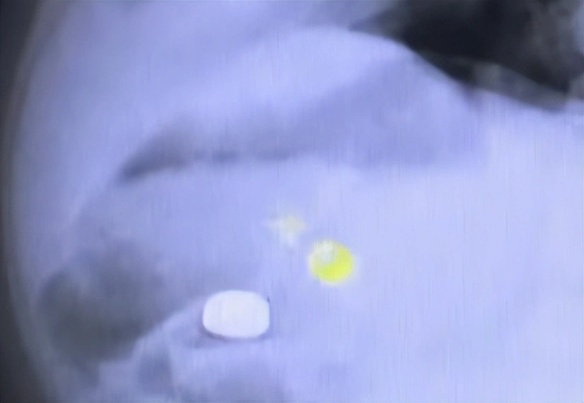 1歲童誤吞電池致終身殘疾！腐蝕食道致穿孔／1食物可以急救！