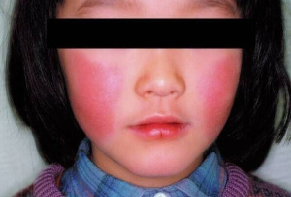 遊日注意！日本沖繩那霸市爆「蘋果病」病毒傳播力強暫無藥物可醫！孕婦感染恐流產 