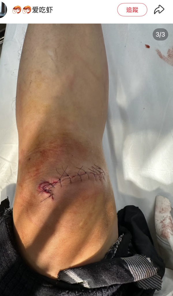 事主滑雪受傷(圖片：愛吃蝦@小紅書）