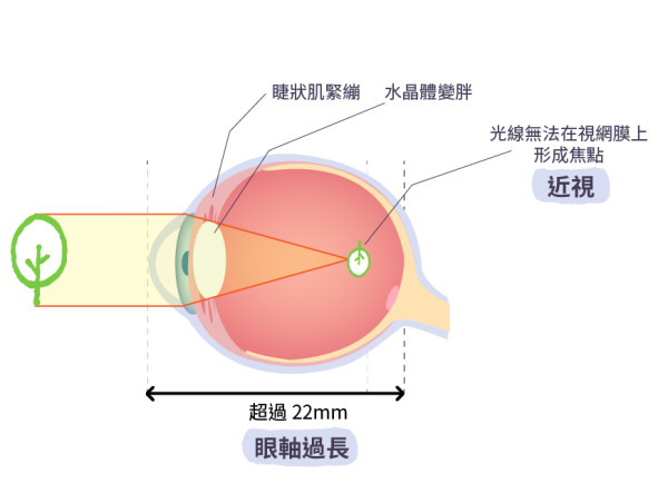 家長注意 6歲女童近視深達1200度 醫生警告恐有失明危機 附10大護眼貼士