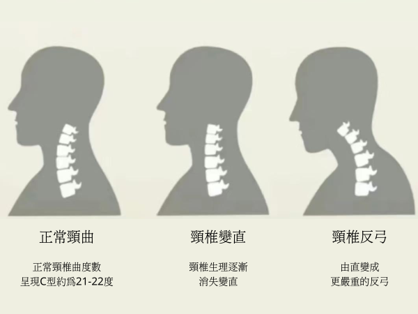 頸椎急救 20 歲「低頭族」頸椎老化似60歲 1習慣等同60磅保齡球掛頸 【附3大恐怖後果+3大護頸貼士】