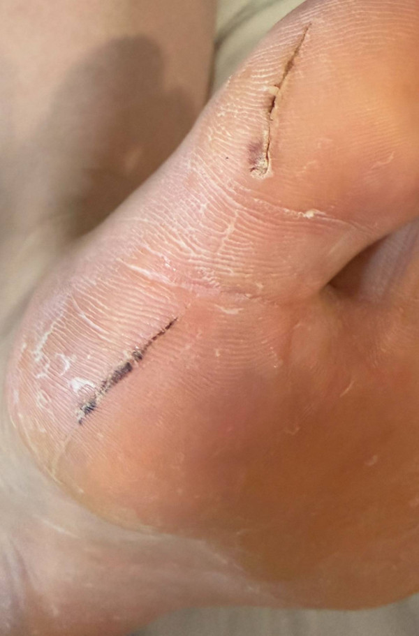 日本溫泉酒店地板藏鐵釘遊客踩中流血!酒店冷處理要求事主刪文否則反告