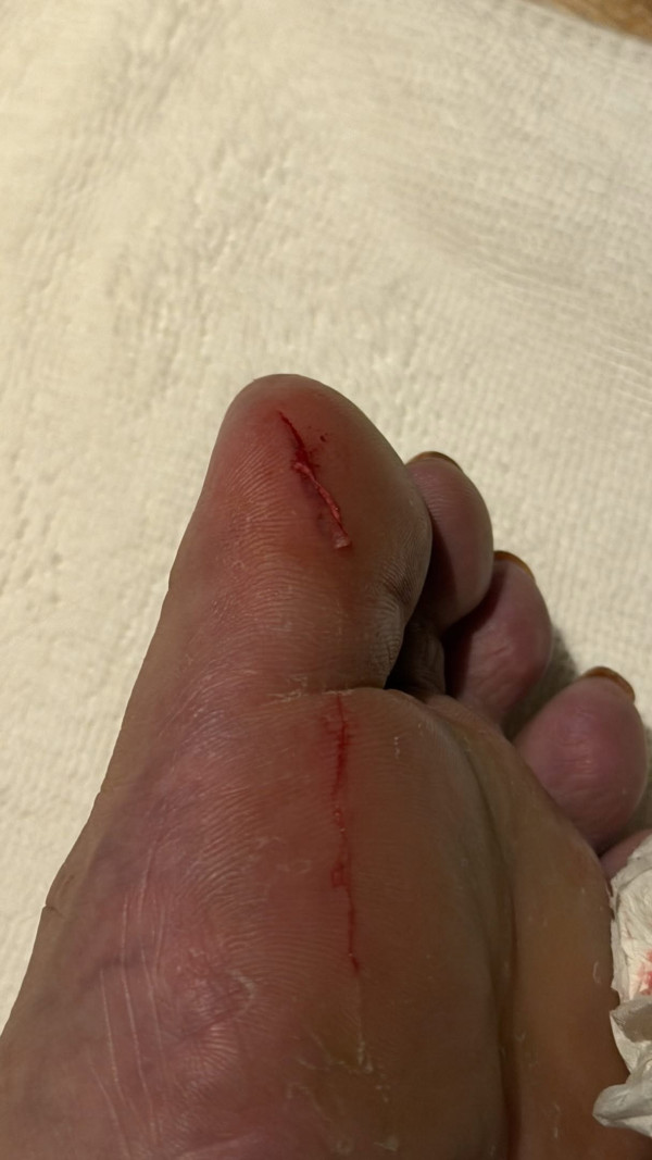 日本溫泉酒店地板藏鐵釘遊客踩中流血!酒店冷處理要求事主刪文否則反告