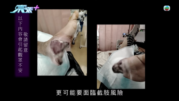 八兩金前妻誤信無牌中醫！腳部嚴重潰爛險截肢？受訪哭訴反被網民鬧爆：無知好可怕