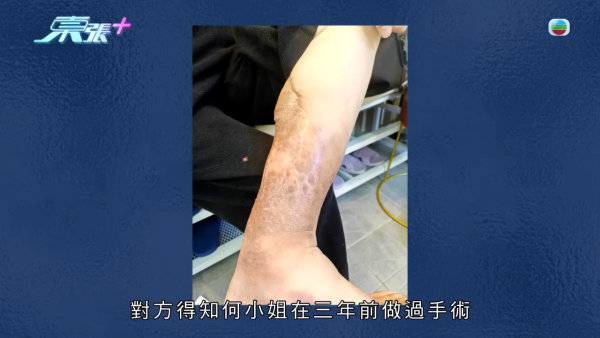 八兩金前妻誤信無牌中醫！腳部嚴重潰爛險截肢？受訪哭訴反被網民鬧爆：無知好可怕