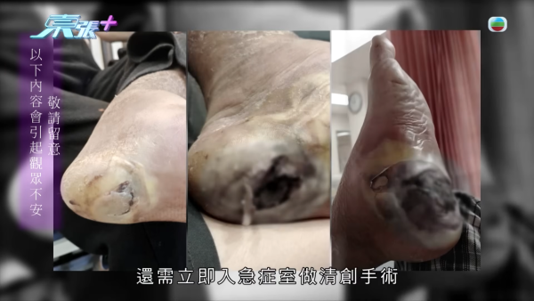 八兩金前妻誤信無牌中醫！腳部嚴重潰爛險截肢？受訪哭訴反被網民鬧爆：無知好可怕