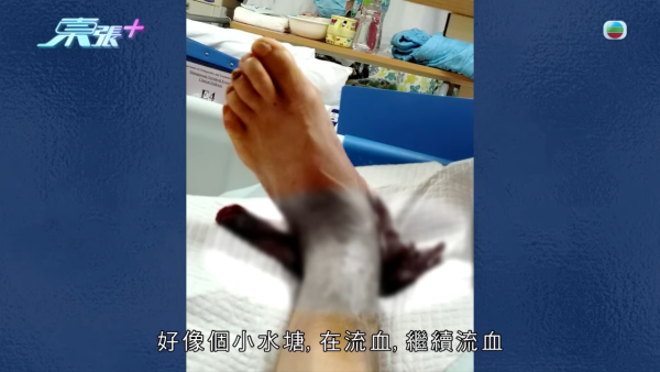 八兩金前妻誤信無牌中醫！腳部嚴重潰爛險截肢？受訪哭訴反被網民鬧爆：無知好可怕
