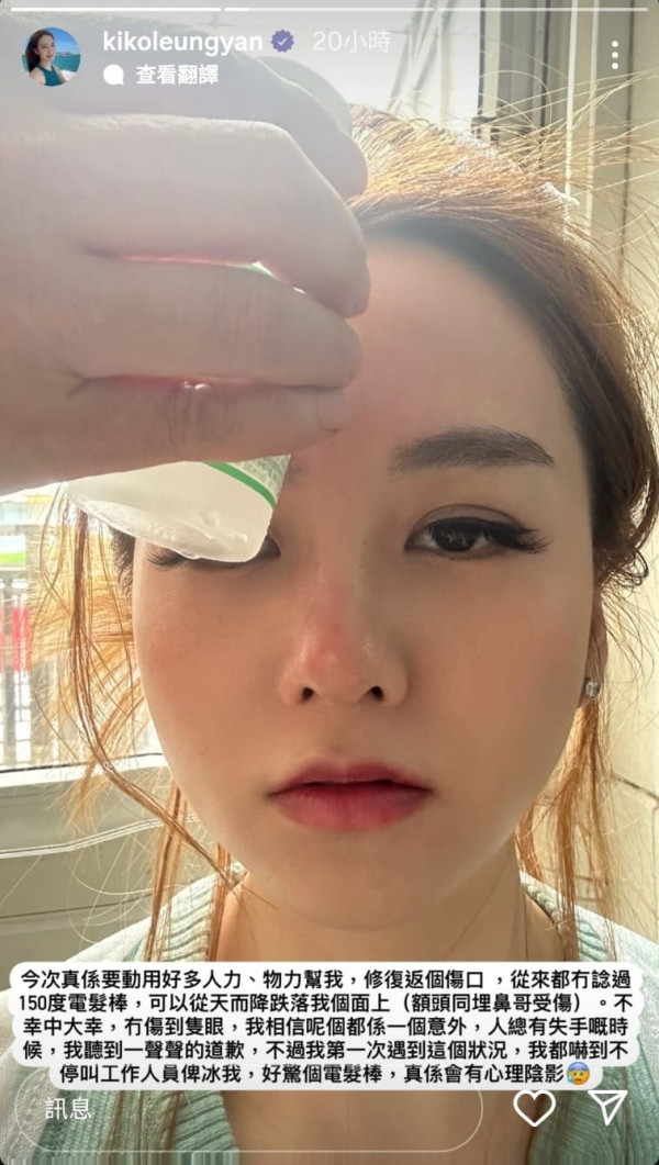 前《愛回家》女藝人遭電髮棒擲面恐毀容 受傷留疤後首度露面揭最新情況