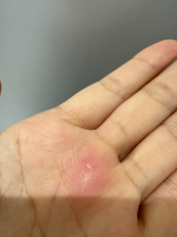 女子借用無線充電器被燙傷 手掌紅腫起水泡 疑機身一物熱到變「電磁爐」