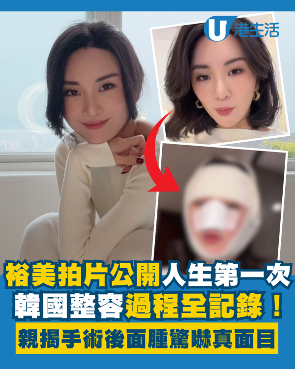 裕美拍片公開人生第一次韓國整容過程 親揭手術後三日面腫驚嚇真面目