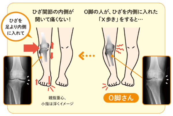 30歲膝蓋就退化？9成港人中招！醫生教一招「無痛甩腳法」助軟骨再生防磨損