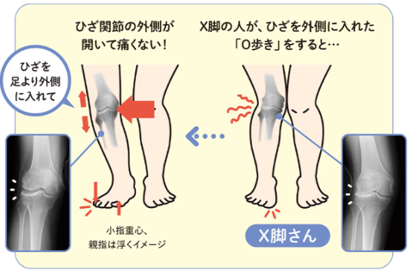 30歲膝蓋就退化？9成港人中招！醫生教一招「無痛甩腳法」助軟骨再生防磨損