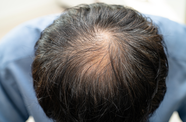 脫髮｜禿頭有救了？研究揭「洋蔥汁」治療禿頭實證：2週見效、6週成功率近9成！