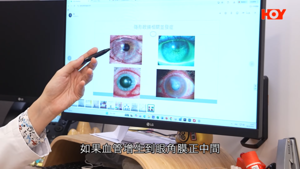 一線搜查｜水貨隱形眼鏡湧入市面！眼科醫生揭2大致盲風險！視光師教一招分真偽行貨