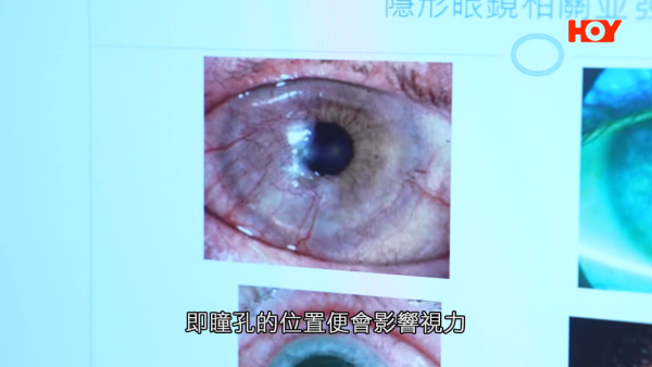 一線搜查｜水貨隱形眼鏡湧入市面！眼科醫生揭2大致盲風險！視光師教一招分真偽行貨