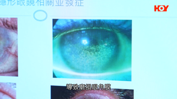 一線搜查｜水貨隱形眼鏡湧入市面！眼科醫生揭2大致盲風險！視光師教一招分真偽行貨