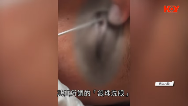 一線搜查｜內地「銀珠洗眼」爆紅！聲稱可助眠、去疲勞？醫生揭3大嚴重風險恐影響視力