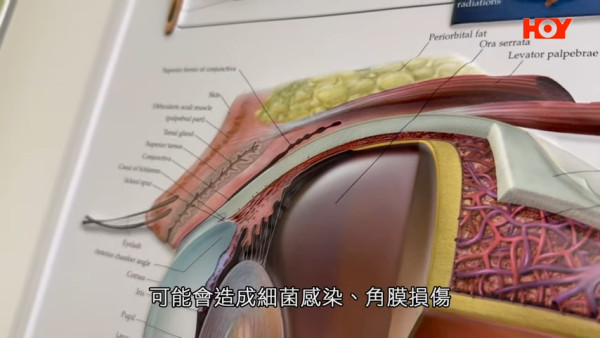 一線搜查｜內地「銀珠洗眼」爆紅！聲稱可助眠、去疲勞？醫生揭3大嚴重風險恐影響視力