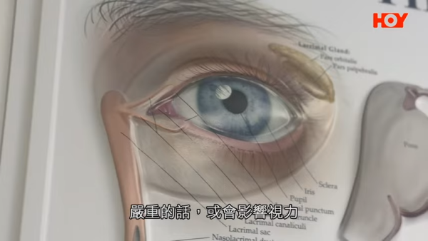 一線搜查｜內地「銀珠洗眼」爆紅！聲稱可助眠、去疲勞？醫生揭3大嚴重風險恐影響視力