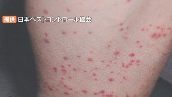 床蝨易入屋小心這款喼!日本5星酒店都中招!入房黃金5分鐘做齊4步防蝨