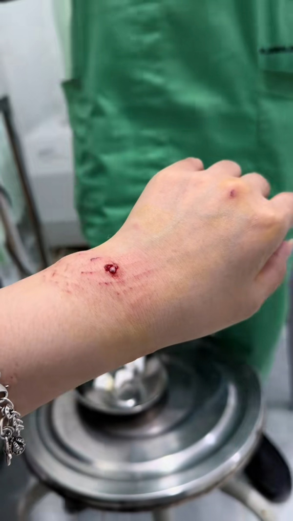 事發一刻曝光！內地女網紅遭鯊魚咬傷感染！ 月經引鯊魚？網民揭真兇係手上一物 