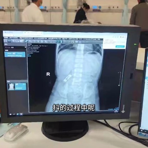 誤吞異物自救法︱1歲女童誤吞3cm髮夾險窒息 醫生教吃3食物急救 即刻安全排出異物