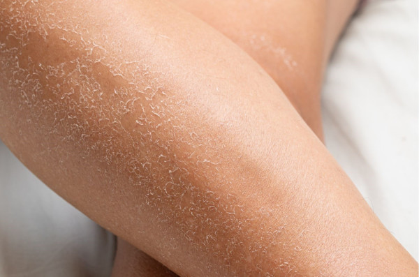 冬天沖熱水涼傷皮膚？醫生警告：超過15分鐘恐誘發皮膚炎　附3招急救止痕