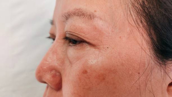 老人斑是內臟衰老警號？75歲名醫親身實測2大飲食去斑法！醫生：單靠護膚品無用