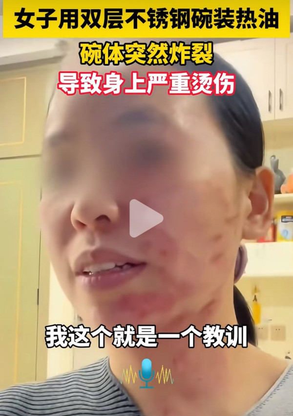 碗也會爆炸？滾油一倒瞬間毀容！女子用「這種碗」盛熱油致嚴重燙傷 專家點名3種碗絕不能裝滾油！