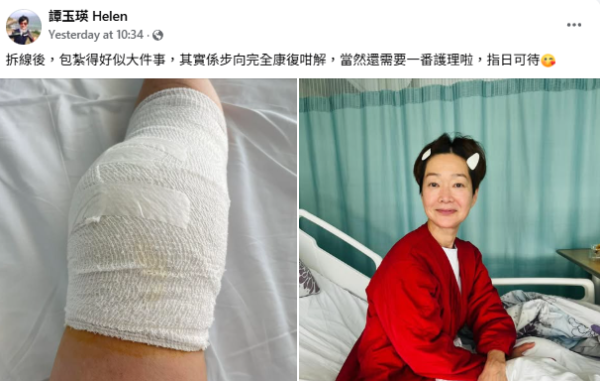 譚玉瑛跑樓梯意外跌倒「膝蓋骨碎裂」 忍痛延遲手術傷勢曝光︰包紮得好似大件事