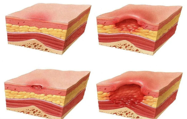 21歲女開電暖毯過夜致屁股爛肉見骨！醫生揭做錯1步致低溫燙傷／附10大暖身食物