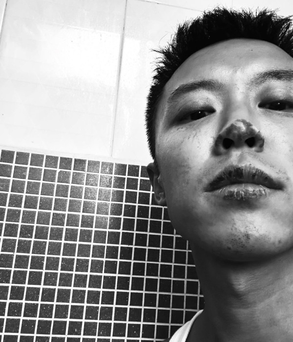 31歲男藝人IG晒恐怖燒傷驚見傷勢嚴重！佈滿血痕險毀容僅留一字惹網民擔心