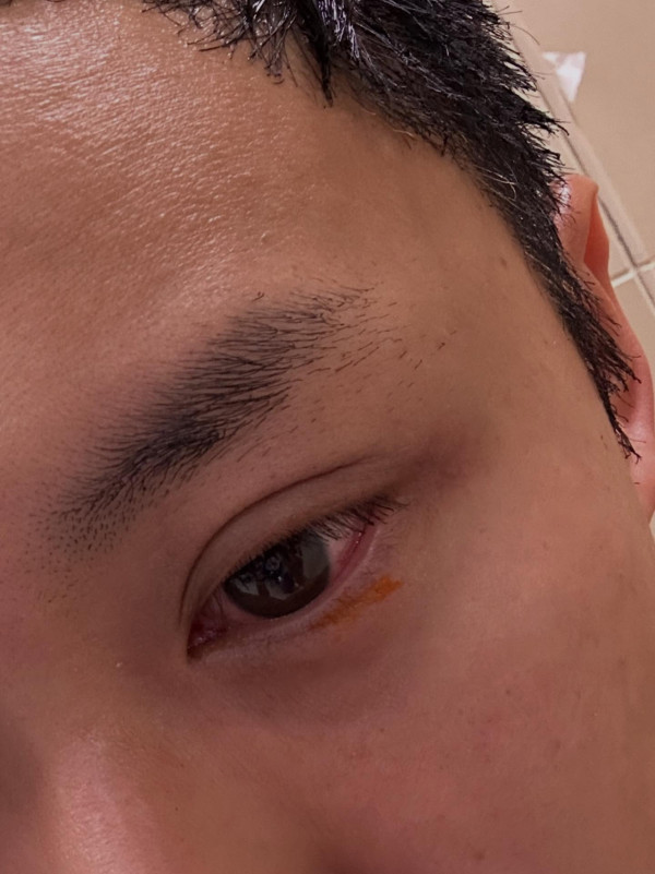 31歲男藝人IG晒恐怖燒傷驚見傷勢嚴重！佈滿血痕險毀容僅留一字惹網民擔心