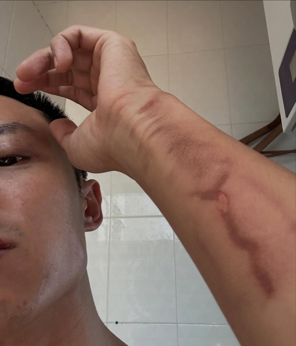 31歲男藝人IG晒恐怖燒傷驚見傷勢嚴重！佈滿血痕險毀容僅留一字惹網民擔心