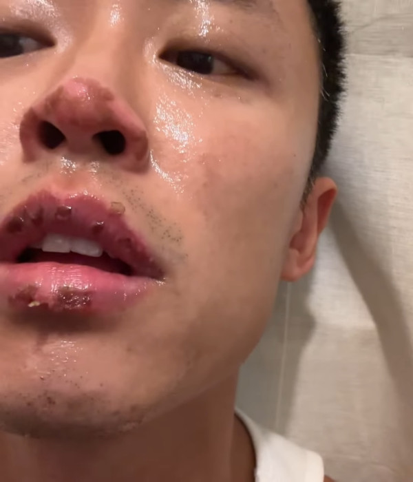 31歲男藝人IG晒恐怖燒傷驚見傷勢嚴重！佈滿血痕險毀容僅留一字惹網民擔心