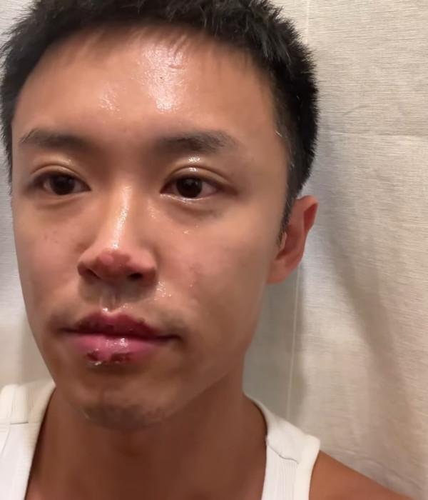 31歲男藝人IG晒恐怖燒傷驚見傷勢嚴重！佈滿血痕險毀容僅留一字惹網民擔心