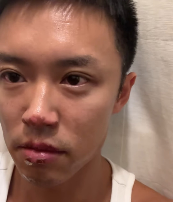 31歲男藝人IG晒恐怖燒傷驚見傷勢嚴重！佈滿血痕險毀容僅留一字惹網民擔心