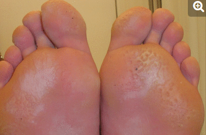 凹陷性角質溶解Pitted keratolysis (圖: Canadian medical association journal)